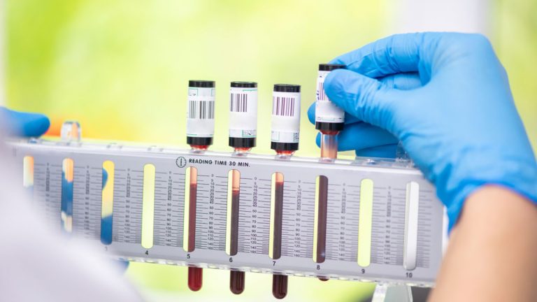 Sedimantasyon (ESR) Testi