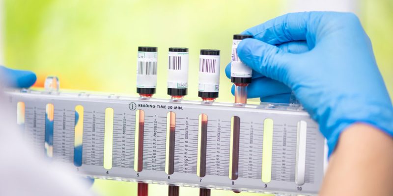 Sedimantasyon (ESR) Testi Nedir?