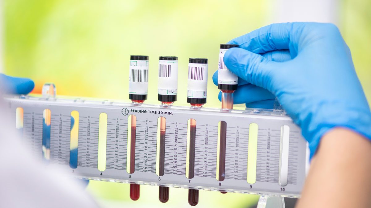 Sedimantasyon (ESR) Testi Nedir?