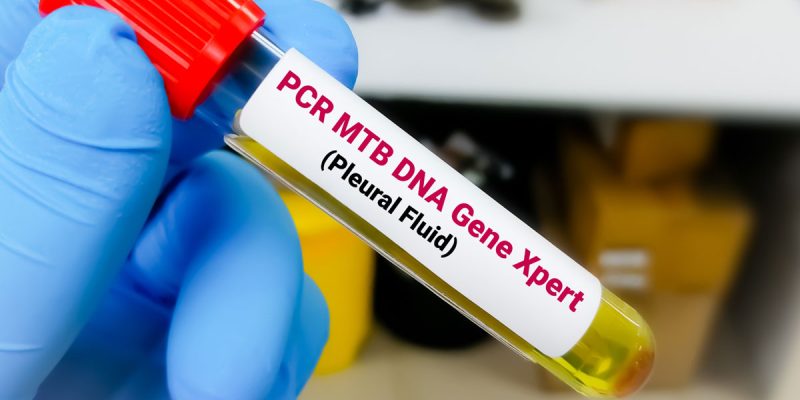 Tüberküloz PCR Testi