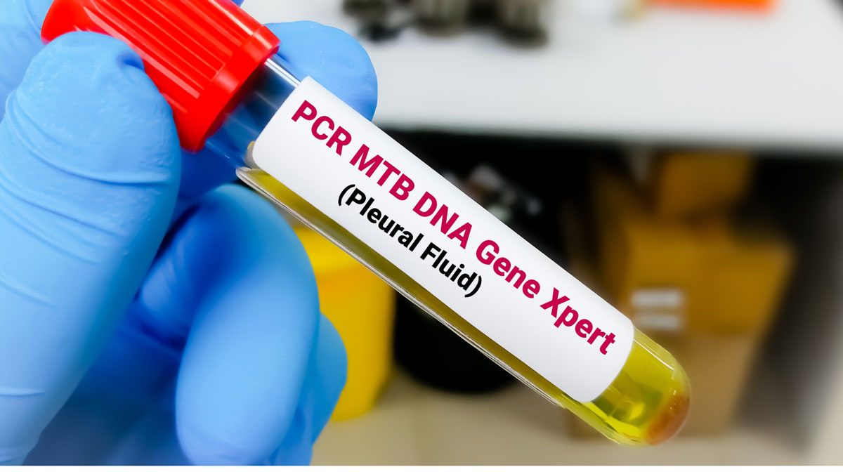 Tüberküloz PCR Testi Tüberküloz PCR Testi