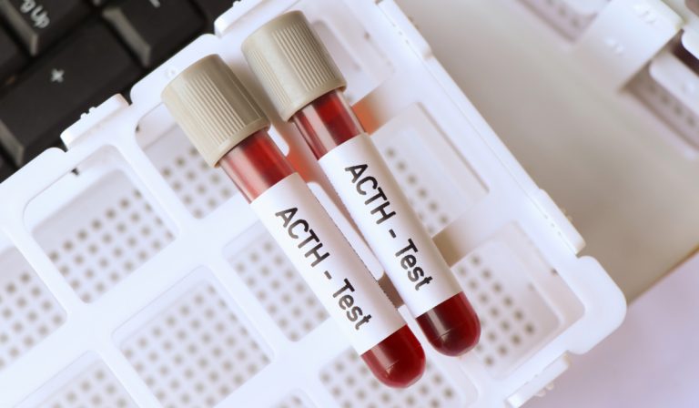 ACTH (Adrenokortikotropik Hormon) Testi