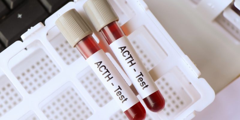 ACTH (Adrenokortikotropik Hormon) Testi