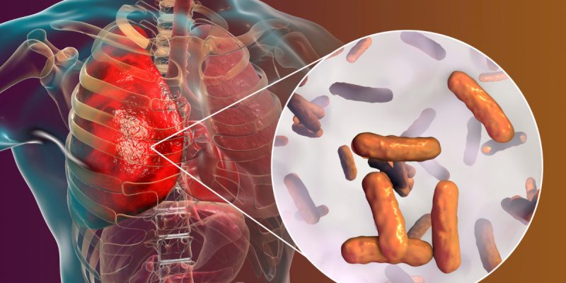 Fırsatçı Enfeksiyonlar Nedir?