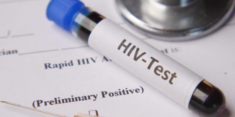 HIV Testi Pozitif Ne Demek?