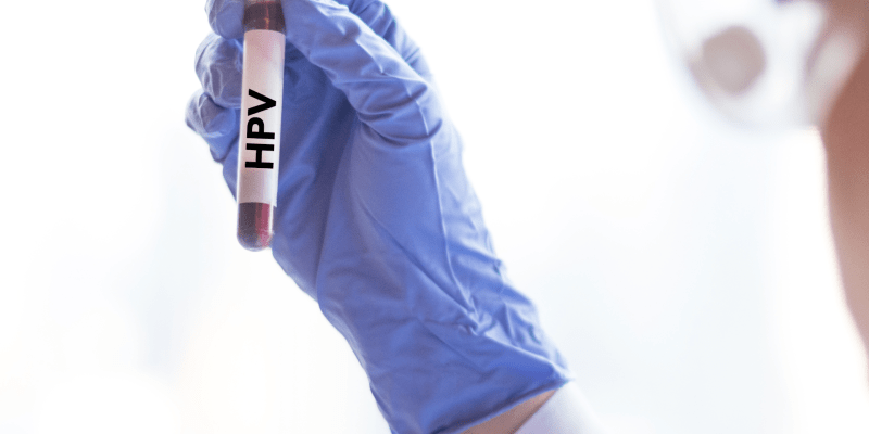 HPV Testi Ne Zaman Yapılmalı?