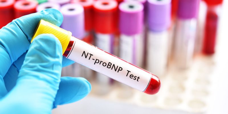 NT-proBNP Testi