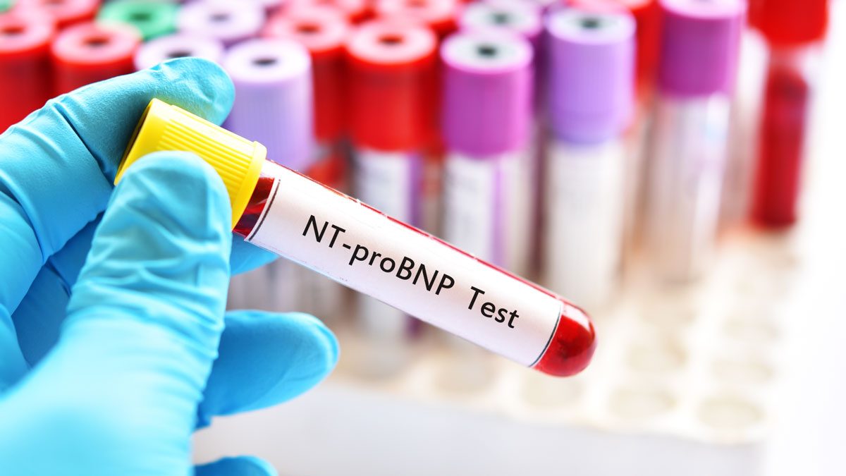NT-proBNP Testi