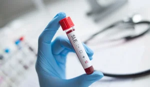 Anti-ds DNA Testi Nedir?