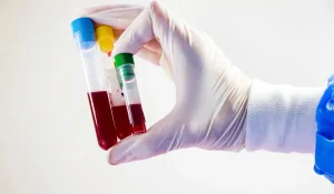 Anti Kardiyolipin (ACA) IgM Testi Nedir?