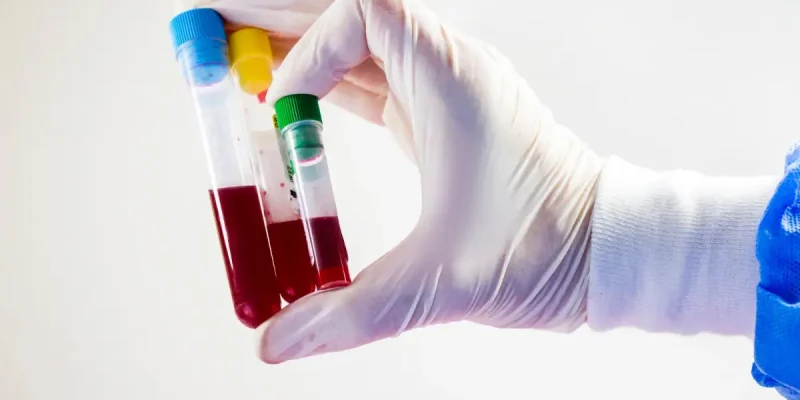 Anti Kardiyolipin (ACA) IgM Testi