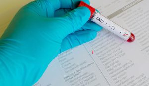 CMV (Sitomegalovirüs) IgM Testi