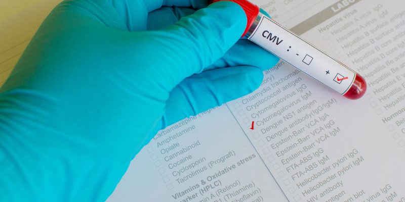 CMV (Sitomegalovirüs) IgM Testi