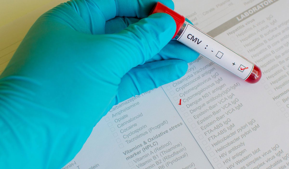 CMV (Sitomegalovirüs) IgM Testi