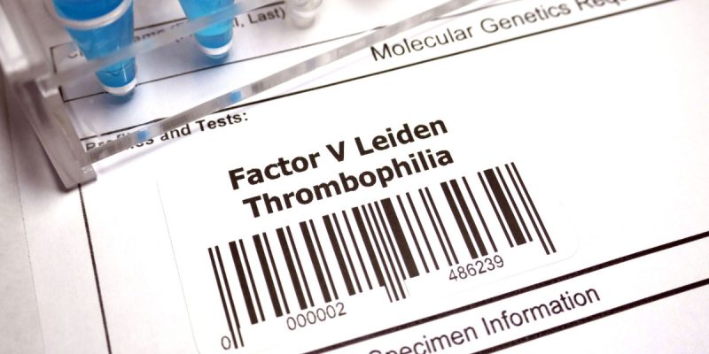 Faktör V Leiden Testi