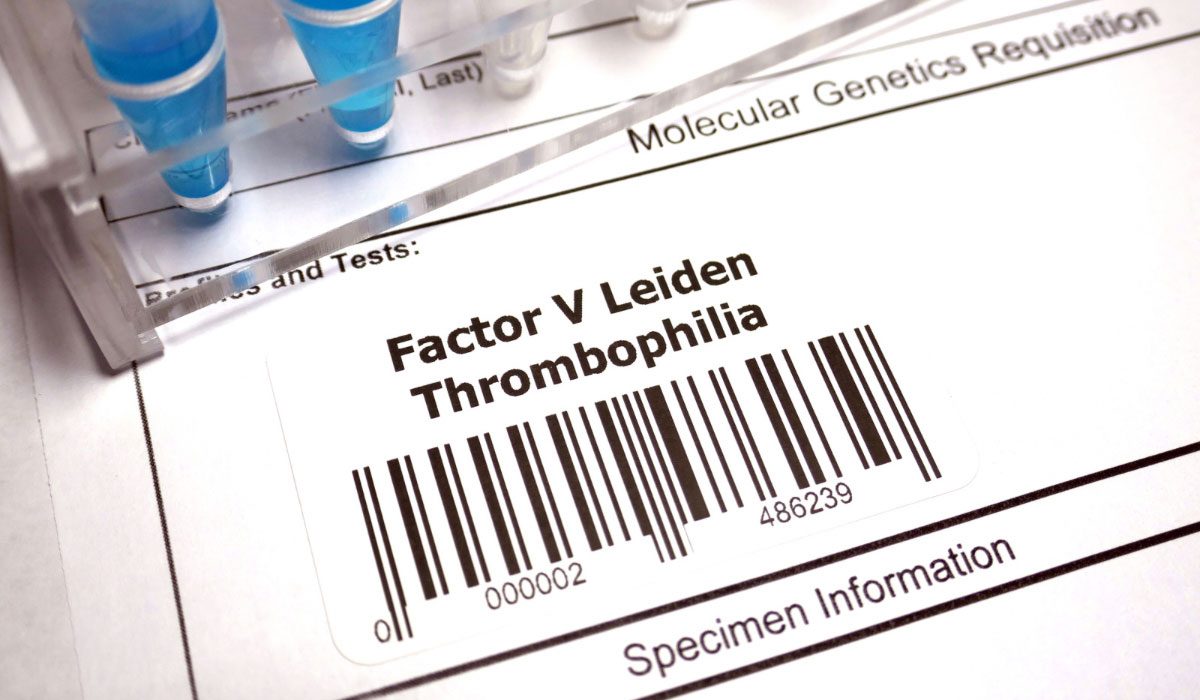 Faktör V Leiden Testi