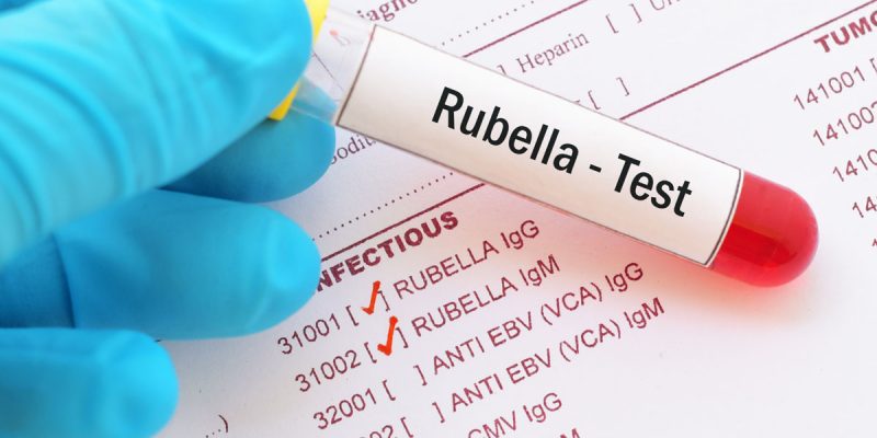 Rubella (Kızamıkçık) IgM Testi