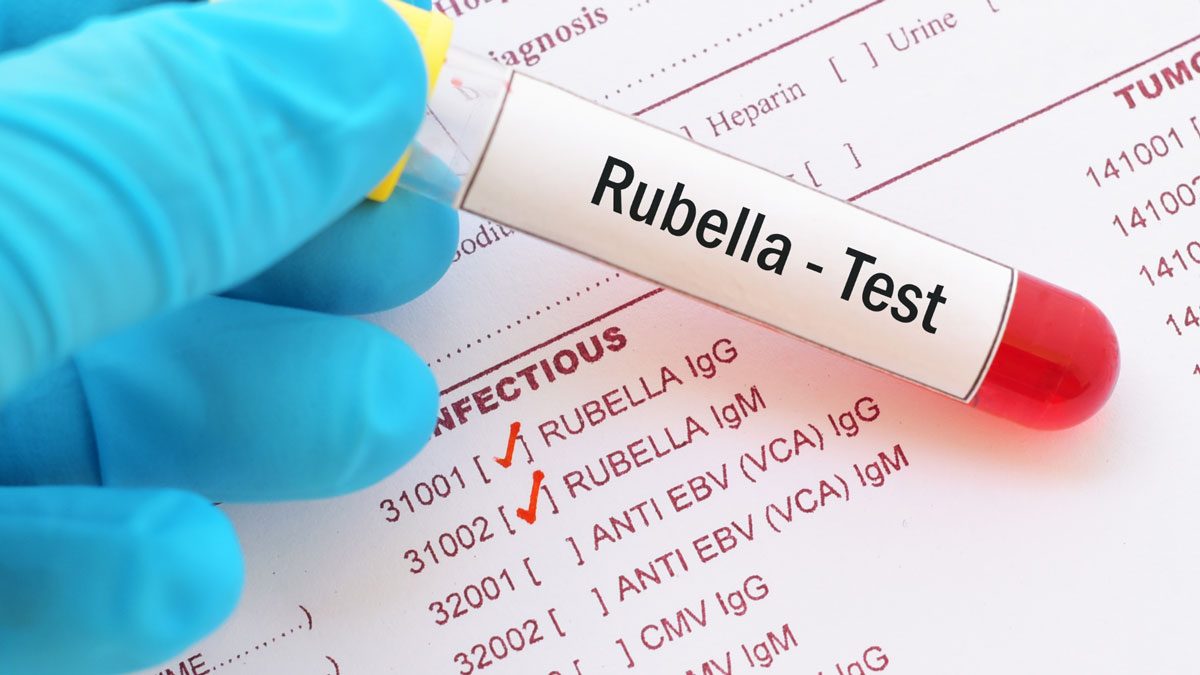Rubella (Kızamıkçık) IgM Testi