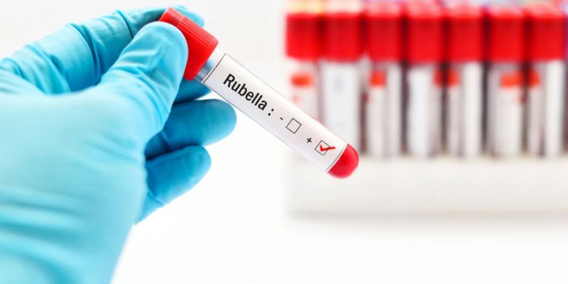 Rubella (Kızamıkçık) IgG Testi