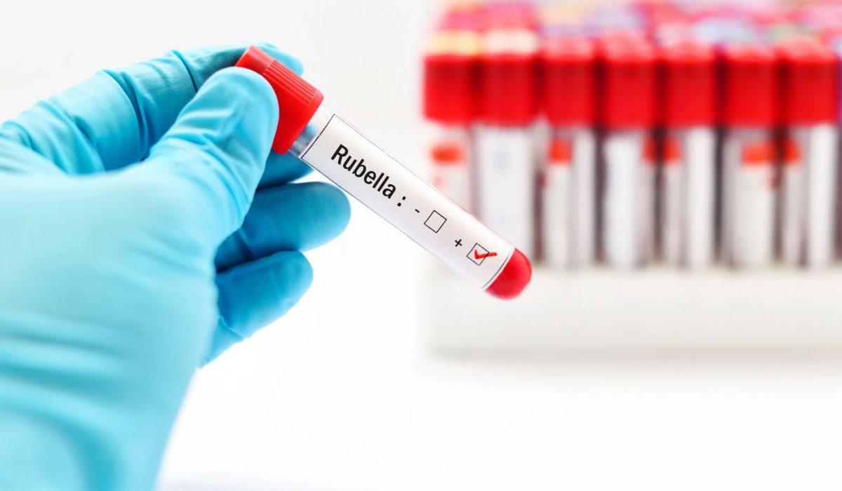Rubella (Kızamıkçık) IgG Testi