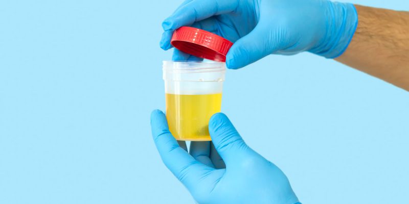 Tam İdrar Tahlili Nedir?