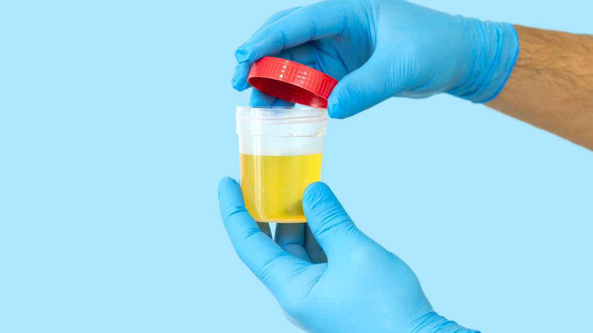 Tam İdrar Tahlili Nedir?