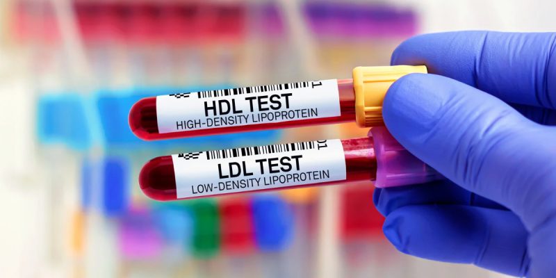 HDL Kolesterol Testi