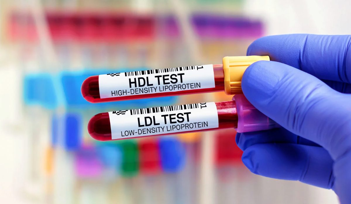 HDL Kolesterol Testi Nedir?
