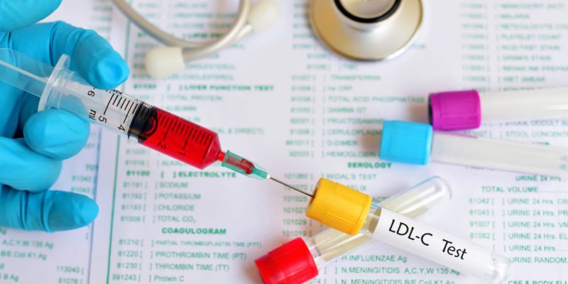 LDL Kolesterol Testi