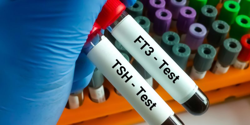 FT3 (Serbest T3) Testi