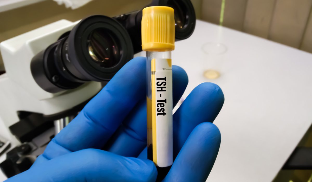 TSH Testi Nedir?