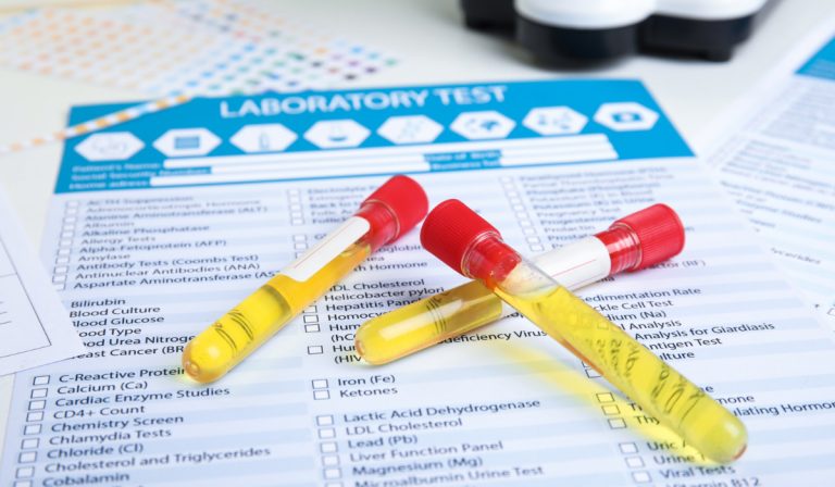 Uyuşturucu Testi (Drug Screen)