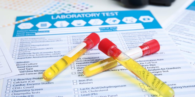 Uyuşturucu Testi (Drug Screen)