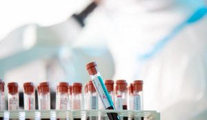 ACE (Angiotensin Converting Enzim) Testi