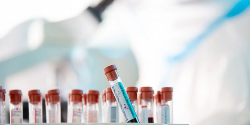 ACE (Angiotensin Converting Enzim) Testi