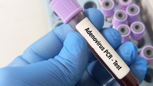 Adenovirüs DNA PCR Testi
