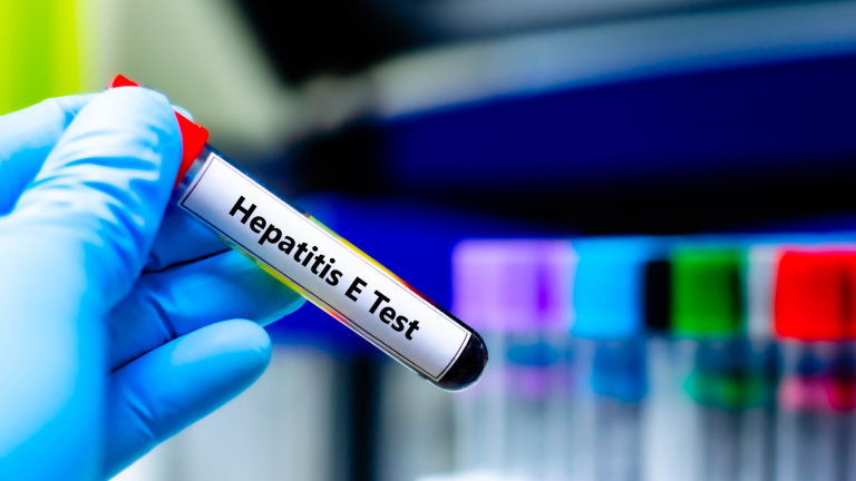 Anti HEV IgG Testi
