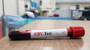 EBV VCA IgM Testi