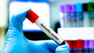 VZV (Varicella Zoster) IgG Testi
