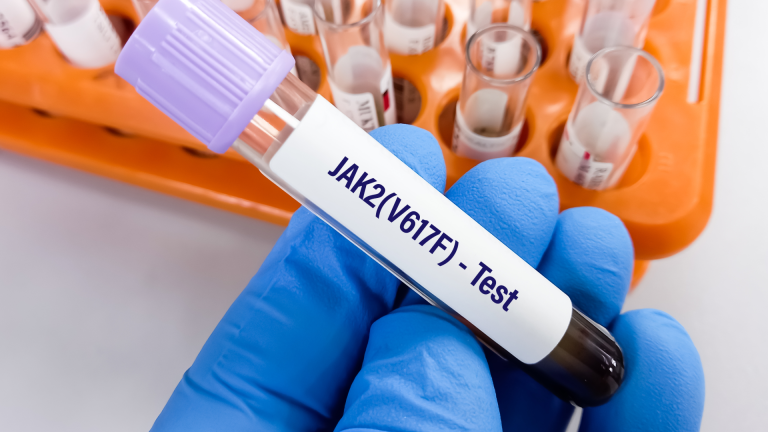 JAK2 Mutasyon Analizi