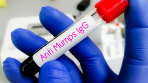 Mumps (Kabakulak) IgG Testi