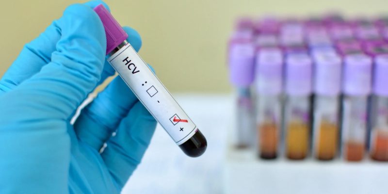 HCV Genotiplendirme Testi