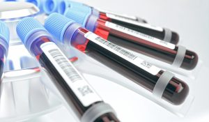 ASCA (Saccharomyces cerevisiae) IgG