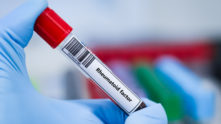 Romatoid Faktör (RF) Testi