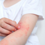 Sp IgE Kakao Alerji Testi