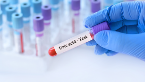 Ürik Asit Testi