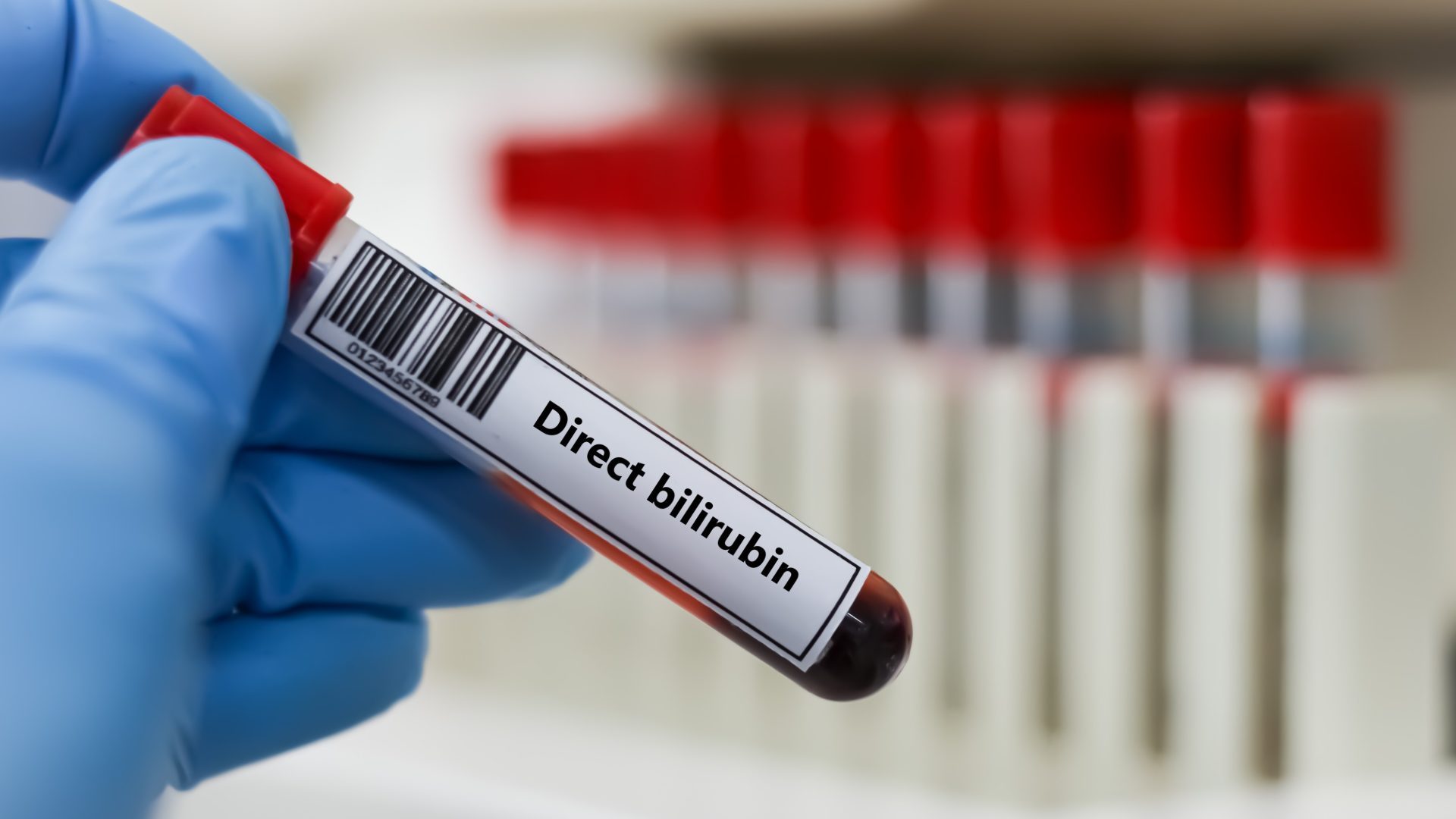Bilirubin Direkt Testi Bilirubin Direkt Testi