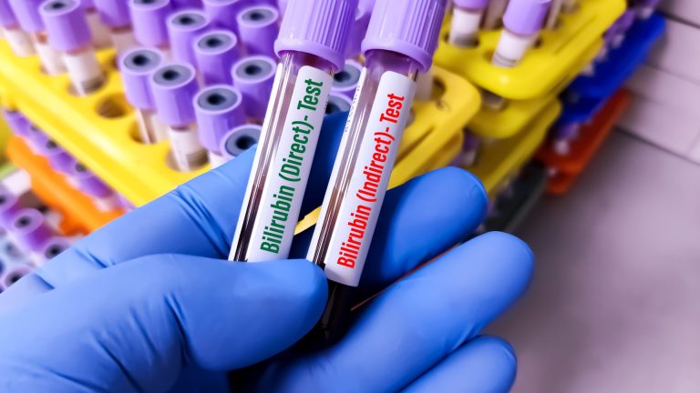 Bilirubin İndirekt Testi