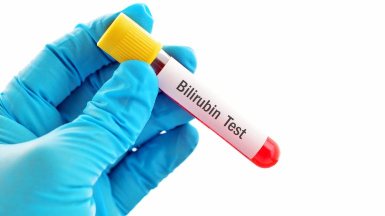 Bilirubin Total Testi