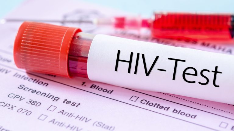 HIV Testi Ne Zaman Yapılır?